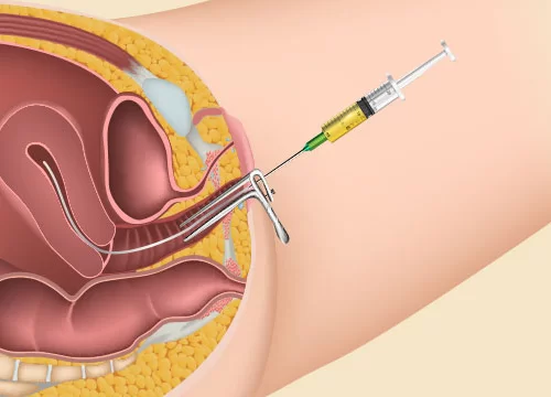 Fertility and IUI treatment