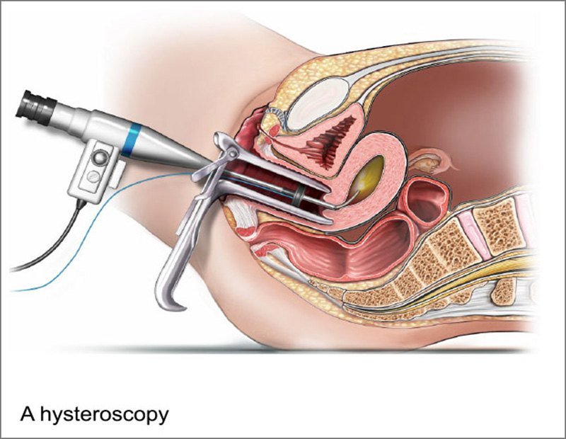 Gynaecological endoscopy