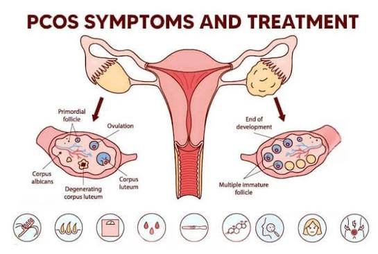 PCOS and PCOD treatment